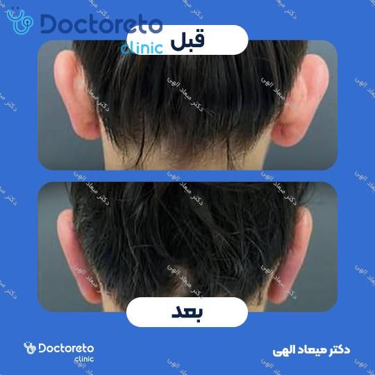 عمل زیبایی گوش (اتوپلاستی)