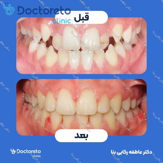 ارتودنسی سرامیکی ( دو فک )