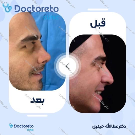 عمل جراحی مجدد زیبایی بینی (رینوپلاستی)