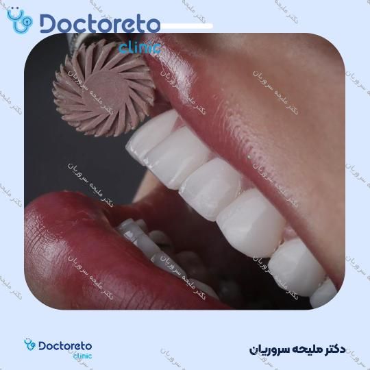 ونیر کامپوزیت (هر واحد)