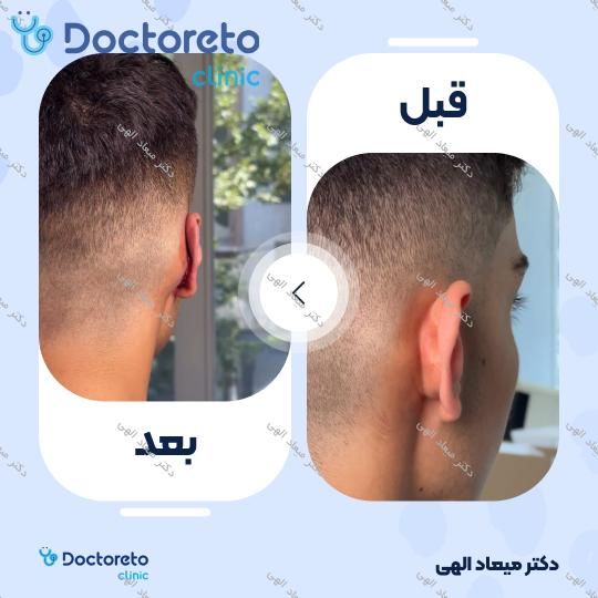 عمل زیبایی گوش (اتوپلاستی)