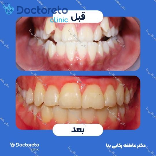 ارتودنسی ثابت (دو فک) با کشیدن دندان