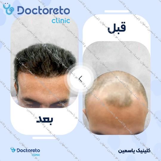 کاشت مو به روش FIT