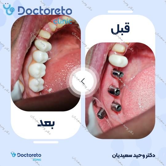 ایمپلنت با روکش زیرکونیوم (هر واحد)