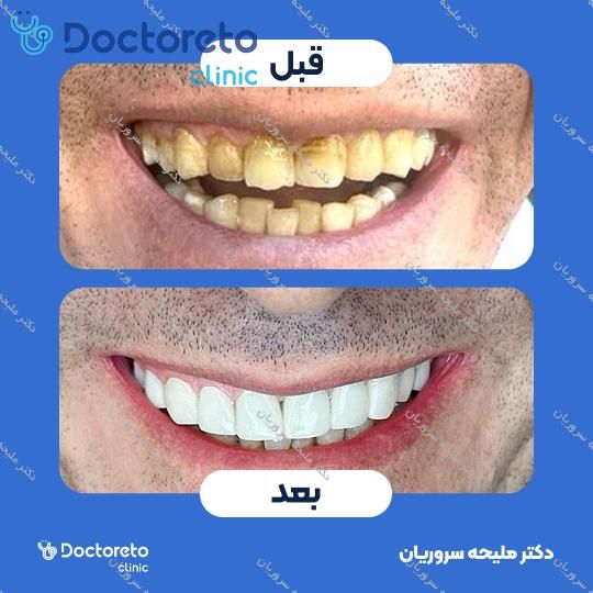 لمینت سرامیکی دندان