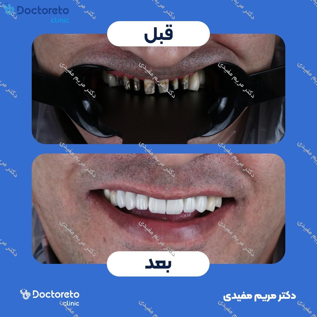 روکش دندان (هر واحد)
