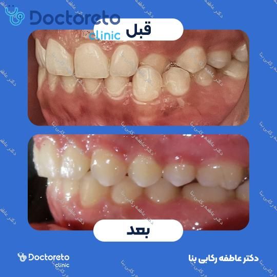 ارتودنسی ثابت ( یک فک )