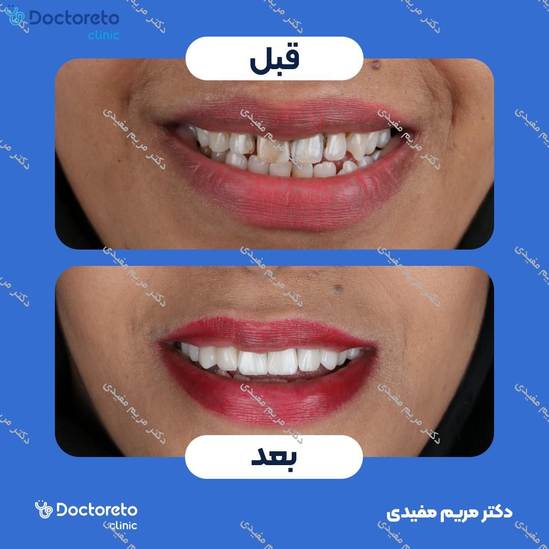 روکش دندان (هر واحد)