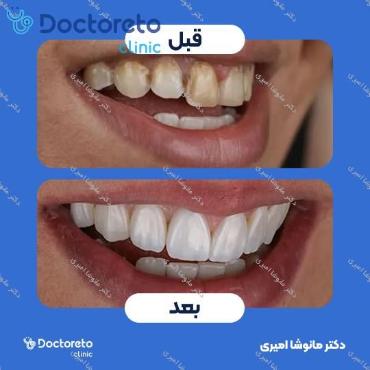 ونیر کامپوزیت (هر واحد)