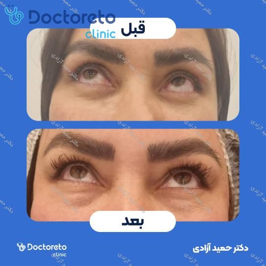 بلفاروپلاستی به روش جراحی