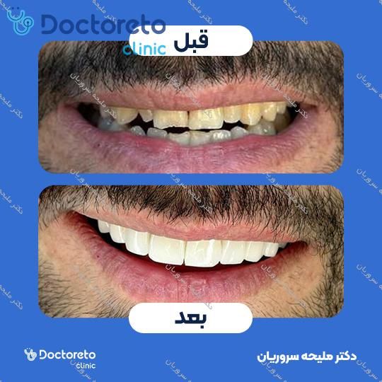 لمینت سرامیکی دندان