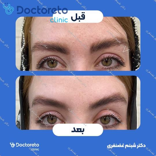 تزریق بوتاکس صورت