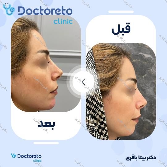 جوانسازی صورت با مزوژل