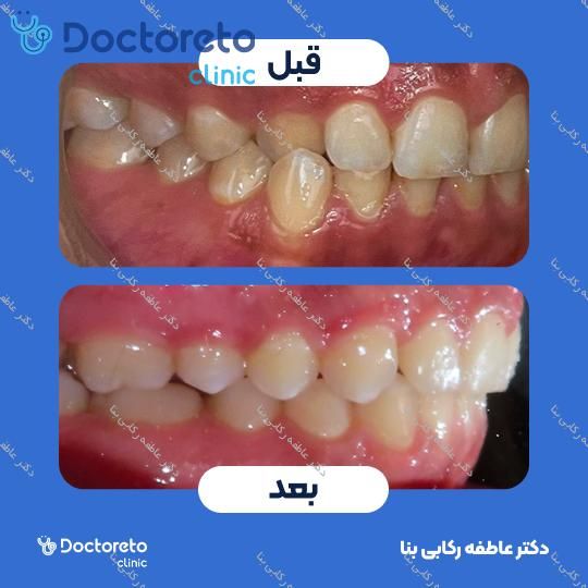 ارتودنسی سرامیکی ( دو فک )