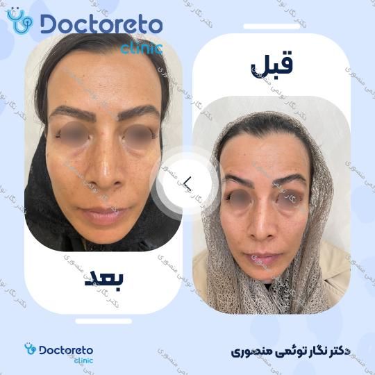 تزریق بوتاکس صورت (پیشانی، خط اخم، دور چشم) با برند مصپورت
