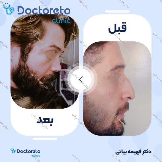 جراحی انحراف بینی (سپتوپلاستی)