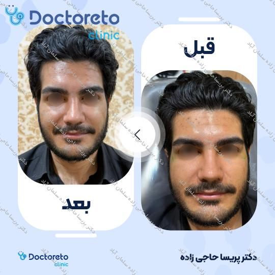 تزریق ژل شقیقه با برند زیشل (1CC)