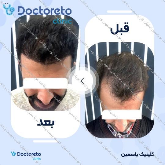 کاشت مو به روش FIT
