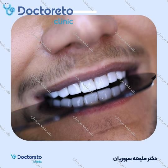 ونیر کامپوزیت (هر واحد)