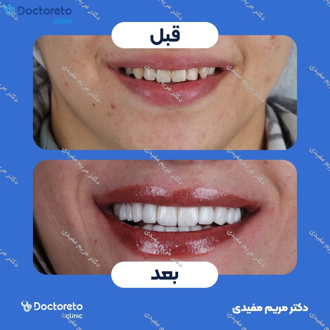 ونیر کامپوزیت دندان (هرواحد)