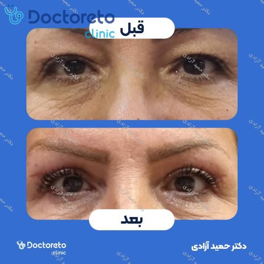 بلفاروپلاستی به روش جراحی