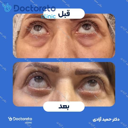 بلفاروپلاستی به روش جراحی