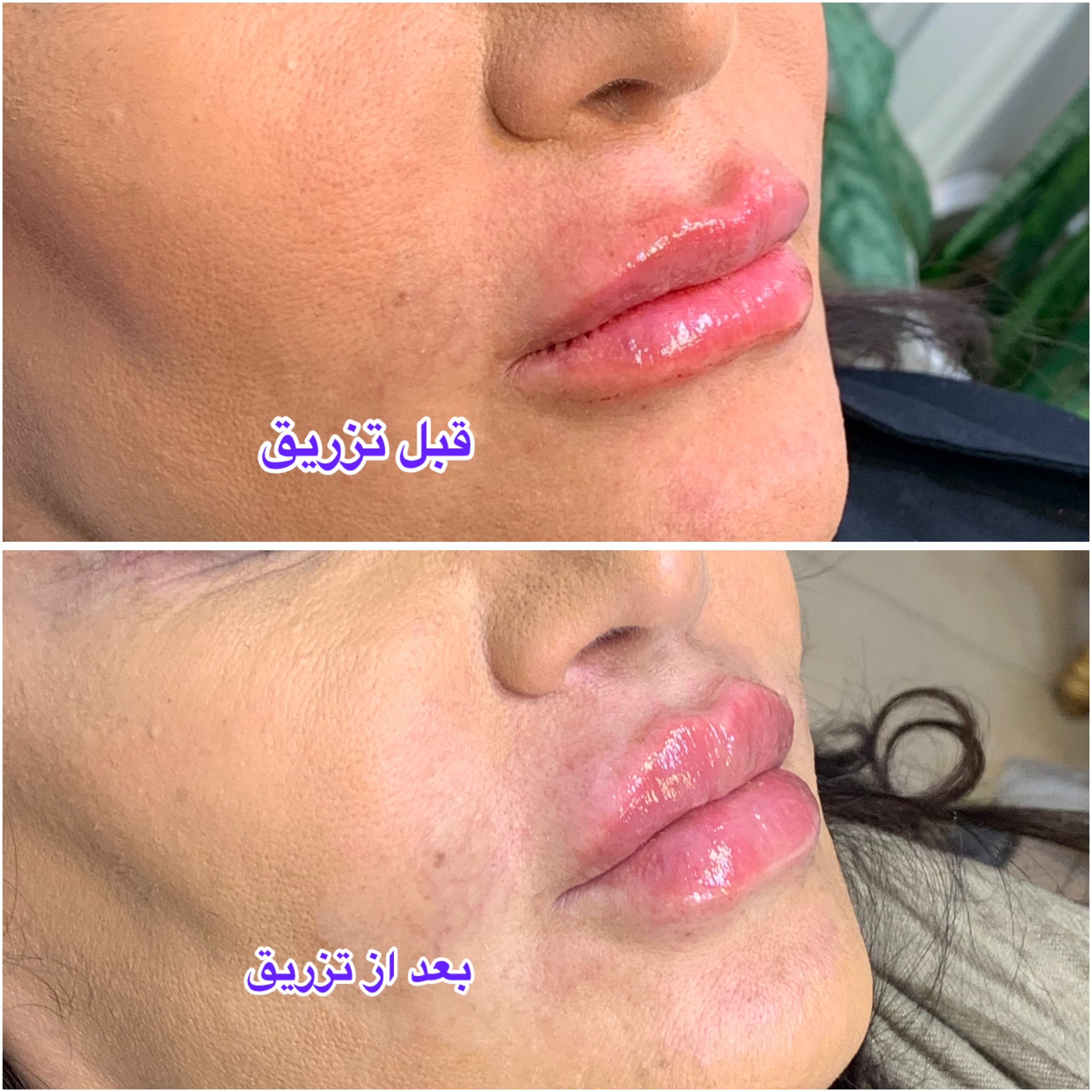 تزریق ژل لب با برند ای پی تی کیو (1cc)