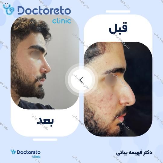 جراحی انحراف بینی (سپتوپلاستی)