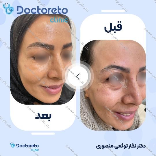 تزریق بوتاکس صورت (پیشانی، خط اخم، دور چشم) با برند مصپورت