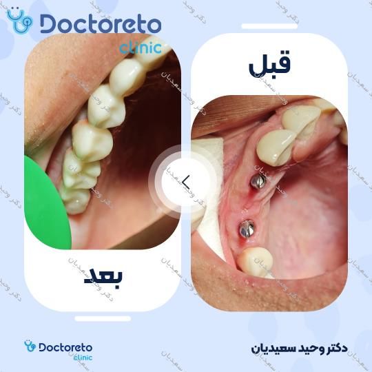ایمپلنت با روکش زیرکونیوم (هر واحد)