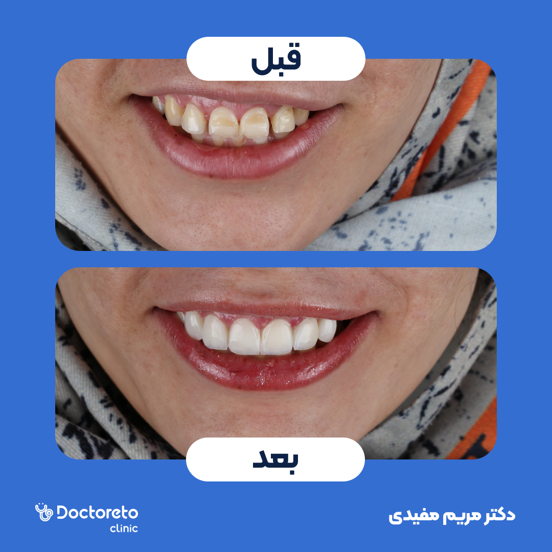 ونیر کامپوزیت سارمکو سویسی (هر واحد)