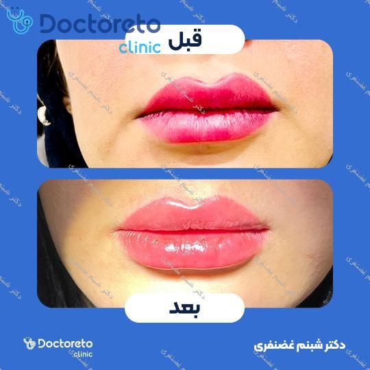 تزریق ژل لب