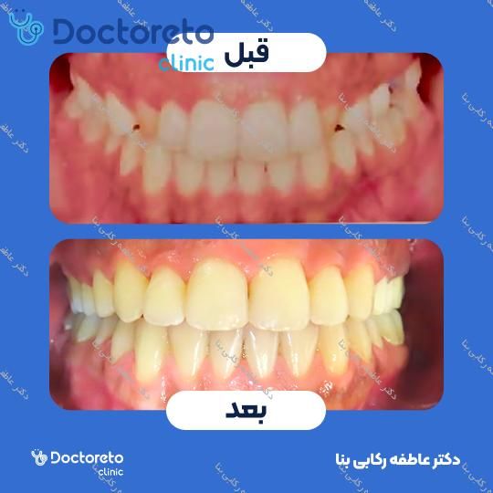 ارتودنسی ثابت ( یک فک )