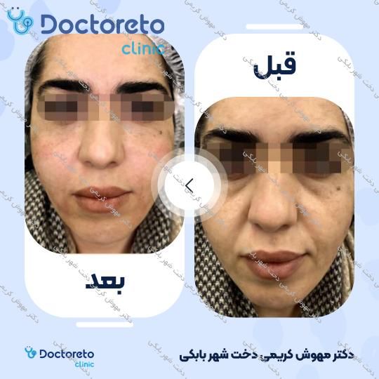 تزریق ژل گونه با برند EPTQ (هر سی سی)