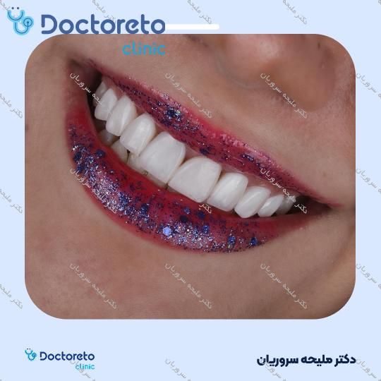 ونیر کامپوزیت (هر واحد)