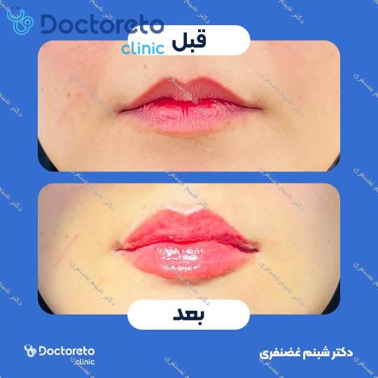 تزریق ژل لب