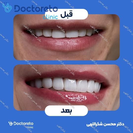 جرمگیری دو فک با بروساژ