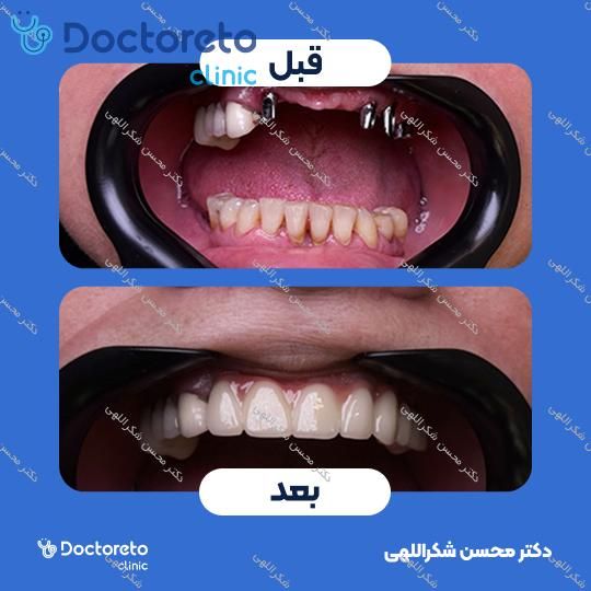 جرمگیری دو فک با بروساژ