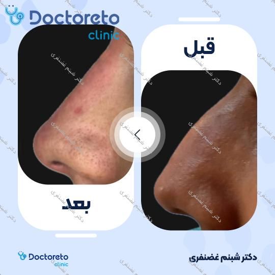 تزریق ژل بینی
