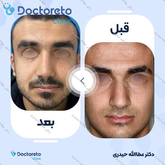 عمل جراحی مجدد زیبایی بینی (رینوپلاستی)