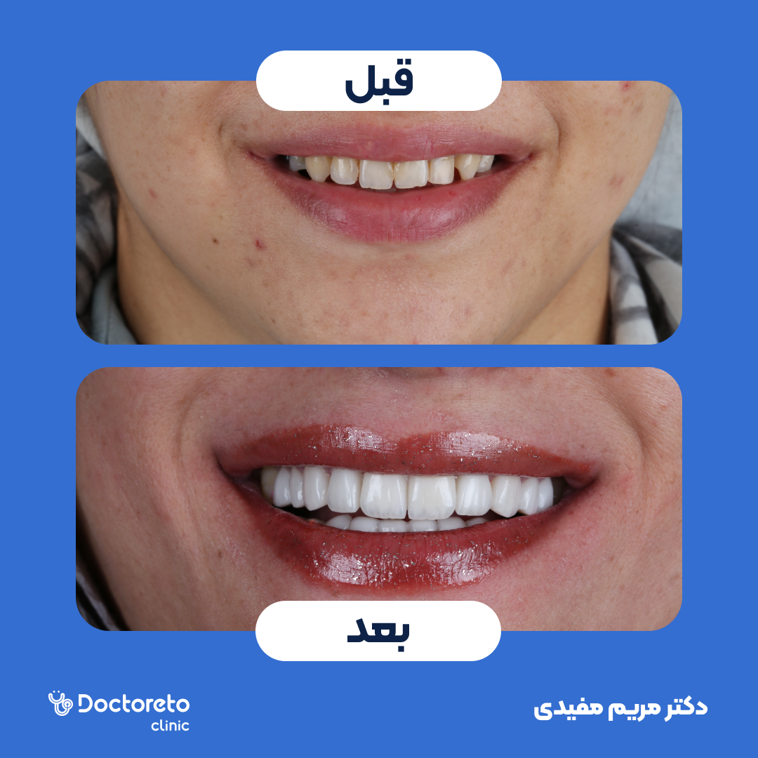 ونیر کامپوزیت با برند توکویاما ژاپنی (هر واحد)