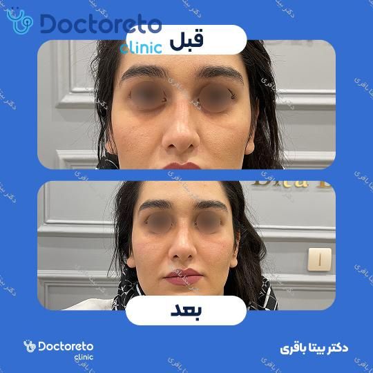 جوانسازی صورت با مزوژل