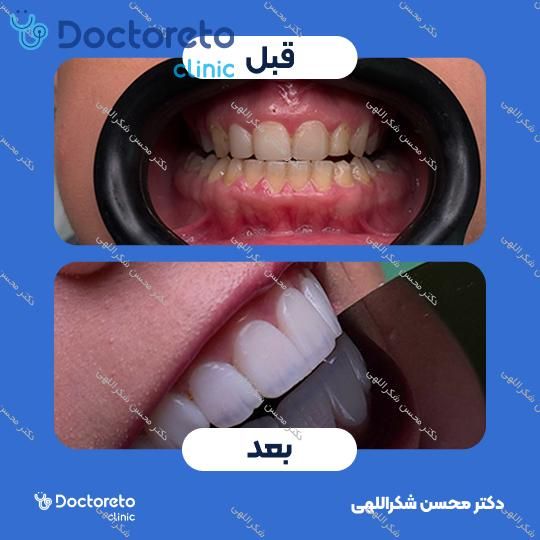 جرمگیری دو فک با بروساژ