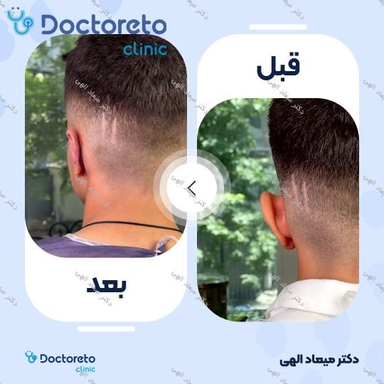 عمل زیبایی گوش (اتوپلاستی)