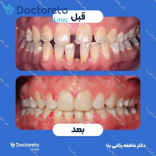 ارتودنسی ثابت ( یک فک )