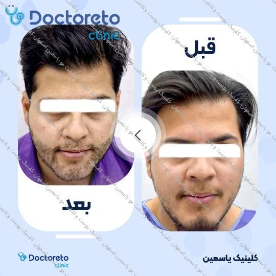 کاشت ریش