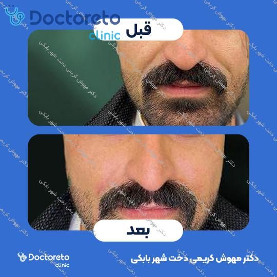 تزریق ژل خط خنده با برند EPTQ (هر سی سی)