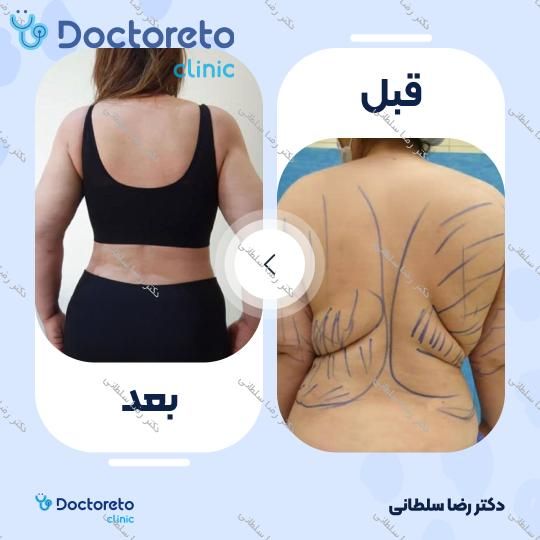 لیپوماتیک شکم و پهلو ها و پشت
