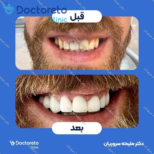 لمینت سرامیکی دندان