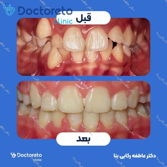 ارتودنسی ثابت ( یک فک )